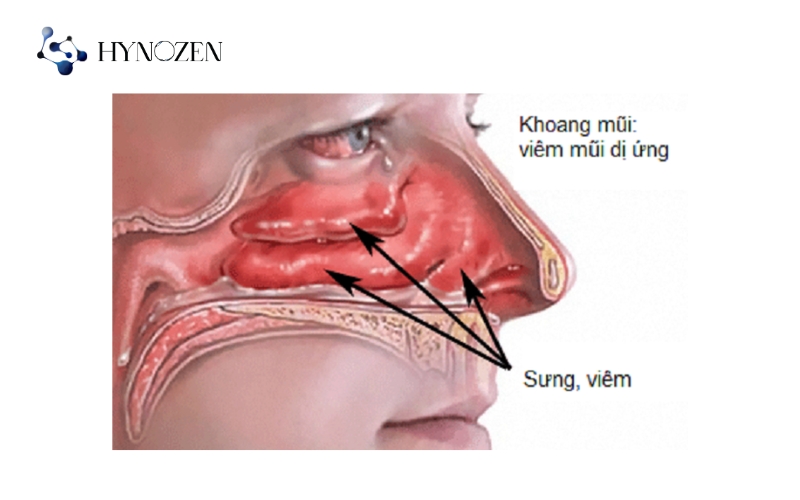 Thế nào là viêm mũi dị ứng?