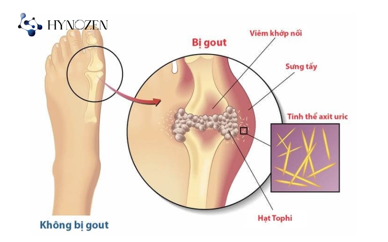 Nguyên nhân dẫn đến bệnh gout